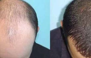hair transplant procedure