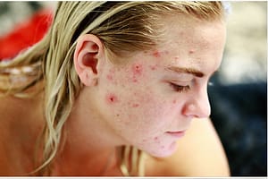 diamond peel prevents acne breakout