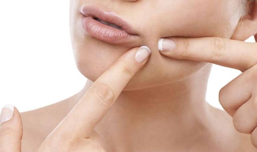 Skin Care: Common Acne Myths